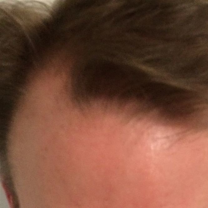 Pro Hair Transplant Clinic - Pro Hair Transplant Clinic