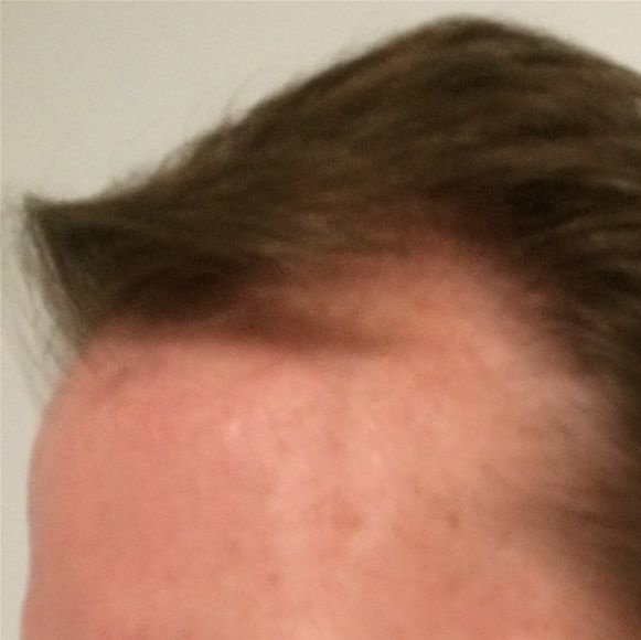 Pro Hair Transplant Clinic - Pro Hair Transplant Clinic