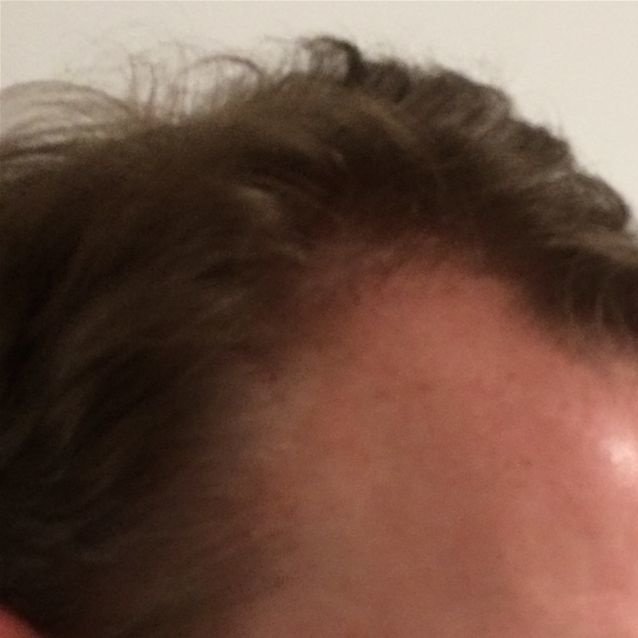 Pro Hair Transplant Clinic - Pro Hair Transplant Clinic