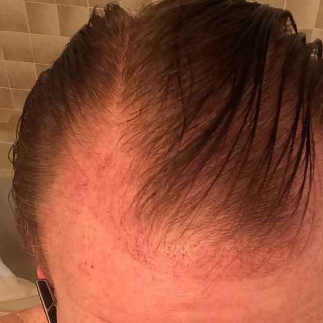 Pro Hair Transplant Clinic - Pro Hair Transplant Clinic