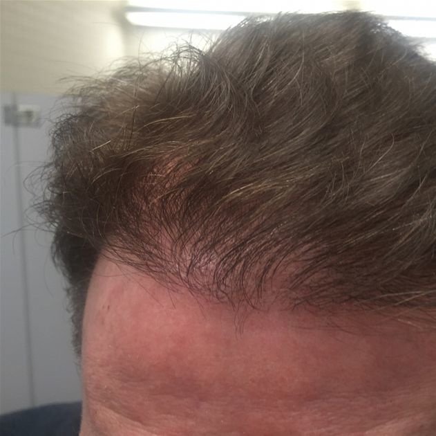 Pro Hair Transplant Clinic - Pro Hair Transplant Clinic