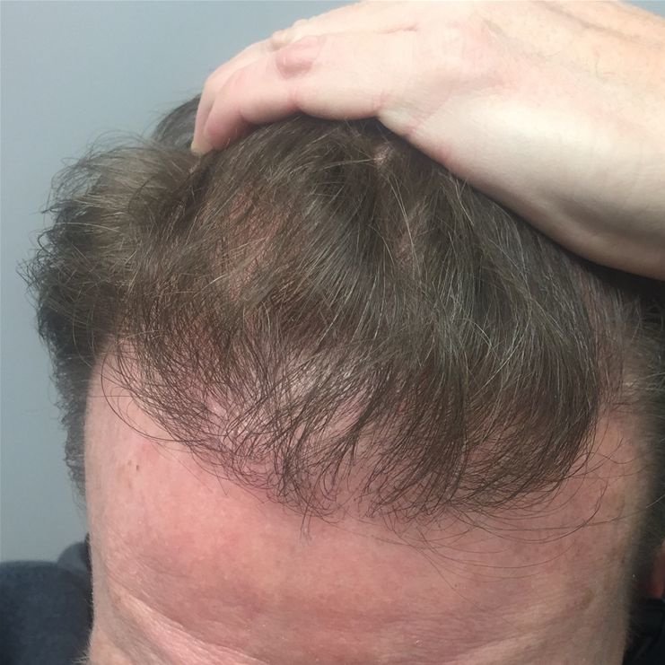 Pro Hair Transplant Clinic - Pro Hair Transplant Clinic