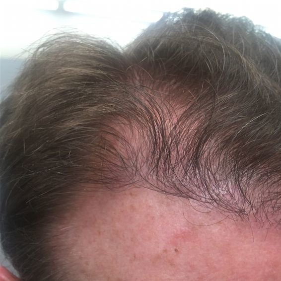 Pro Hair Transplant Clinic - Pro Hair Transplant Clinic