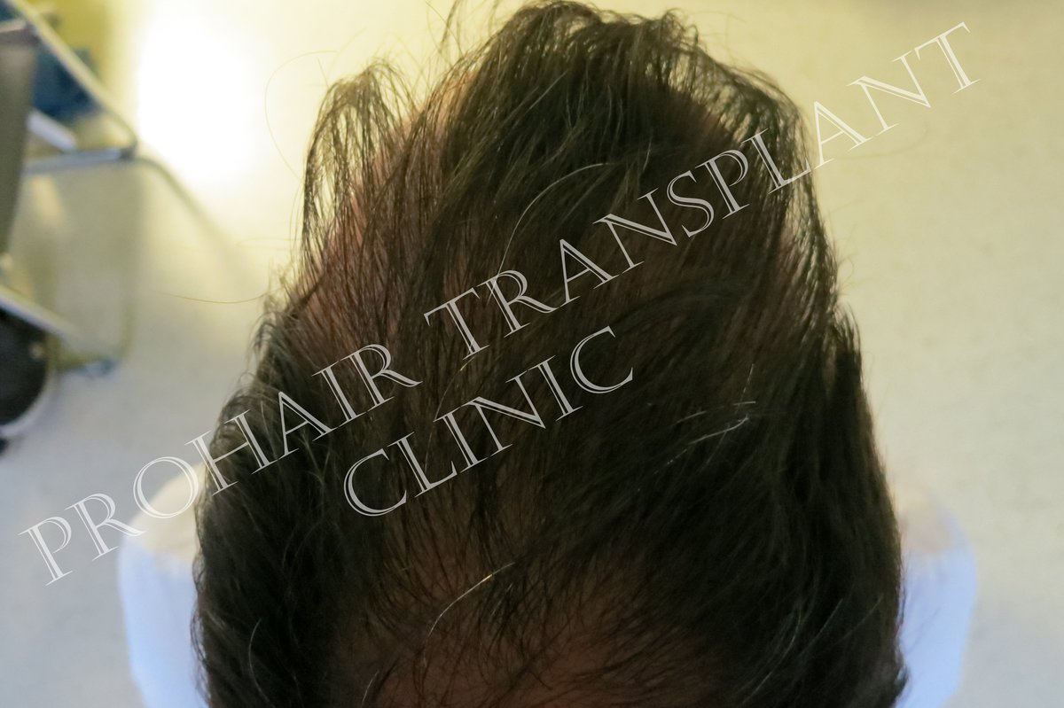Pro Hair Transplant Clinic - Pro Hair Transplant Clinic