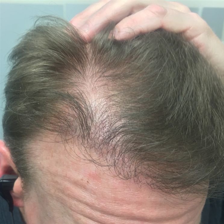 Pro Hair Transplant Clinic - Pro Hair Transplant Clinic