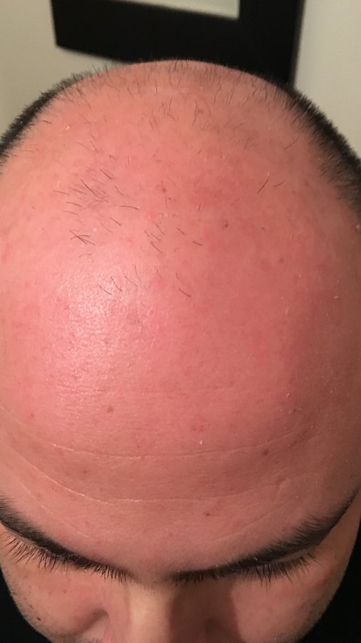 Pro Hair Transplant Clinic - Pro Hair Transplant Clinic