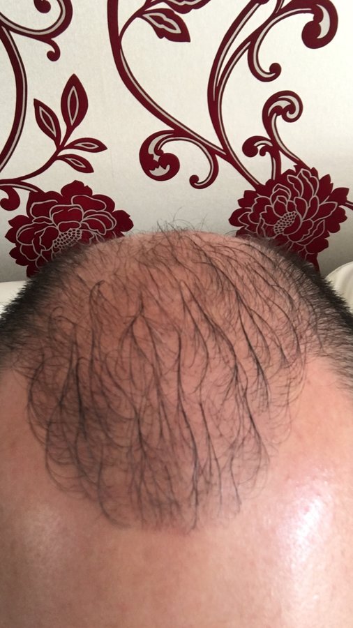 Pro Hair Transplant Clinic - Pro Hair Transplant Clinic