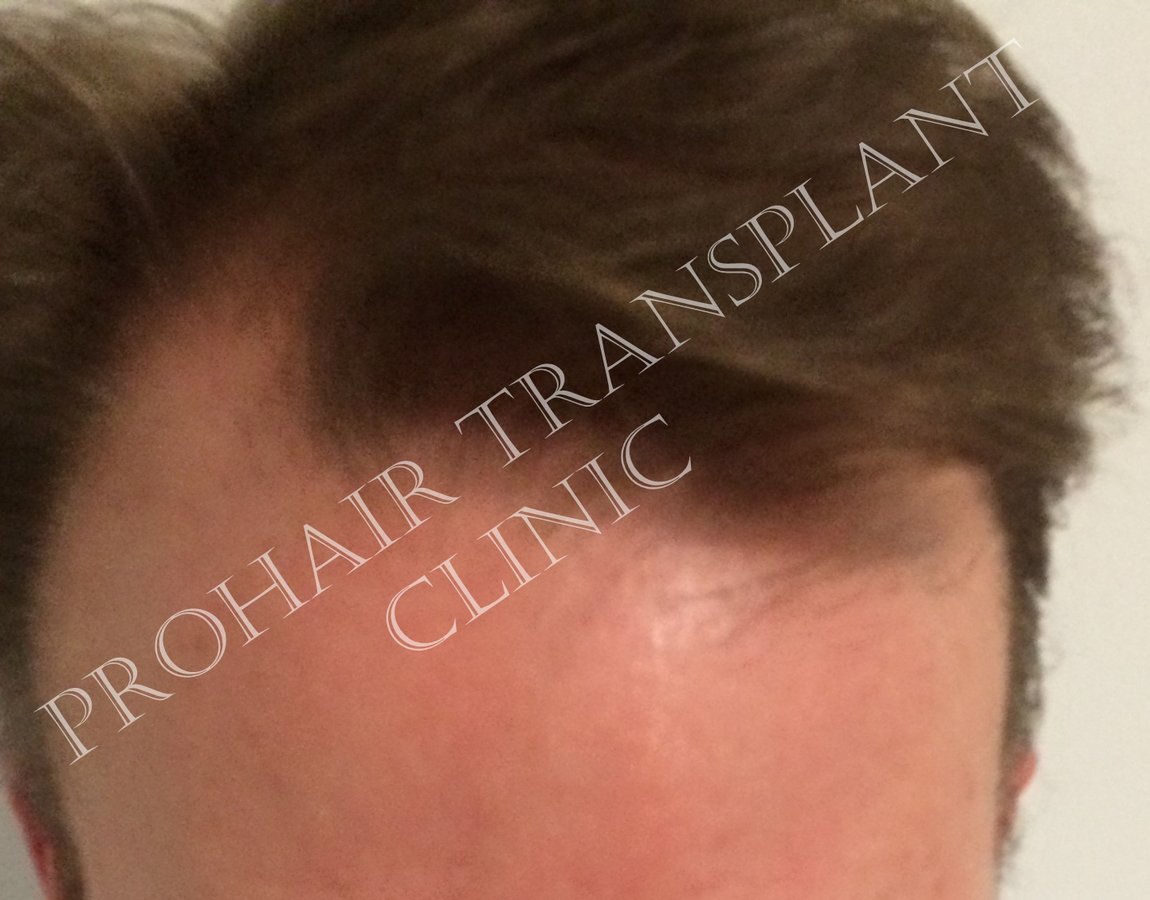 Pro Hair Transplant Clinic - Pro Hair Transplant Clinic
