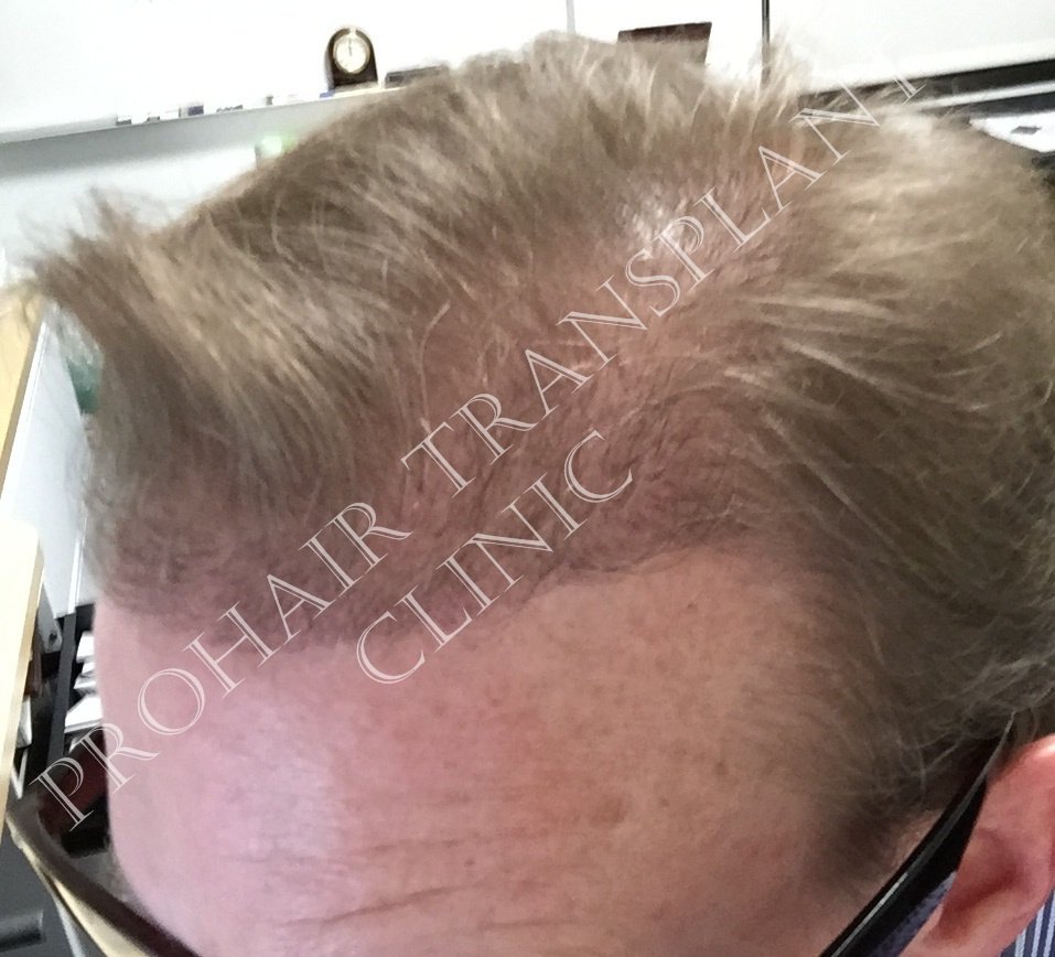 Pro Hair Transplant Clinic - Pro Hair Transplant Clinic