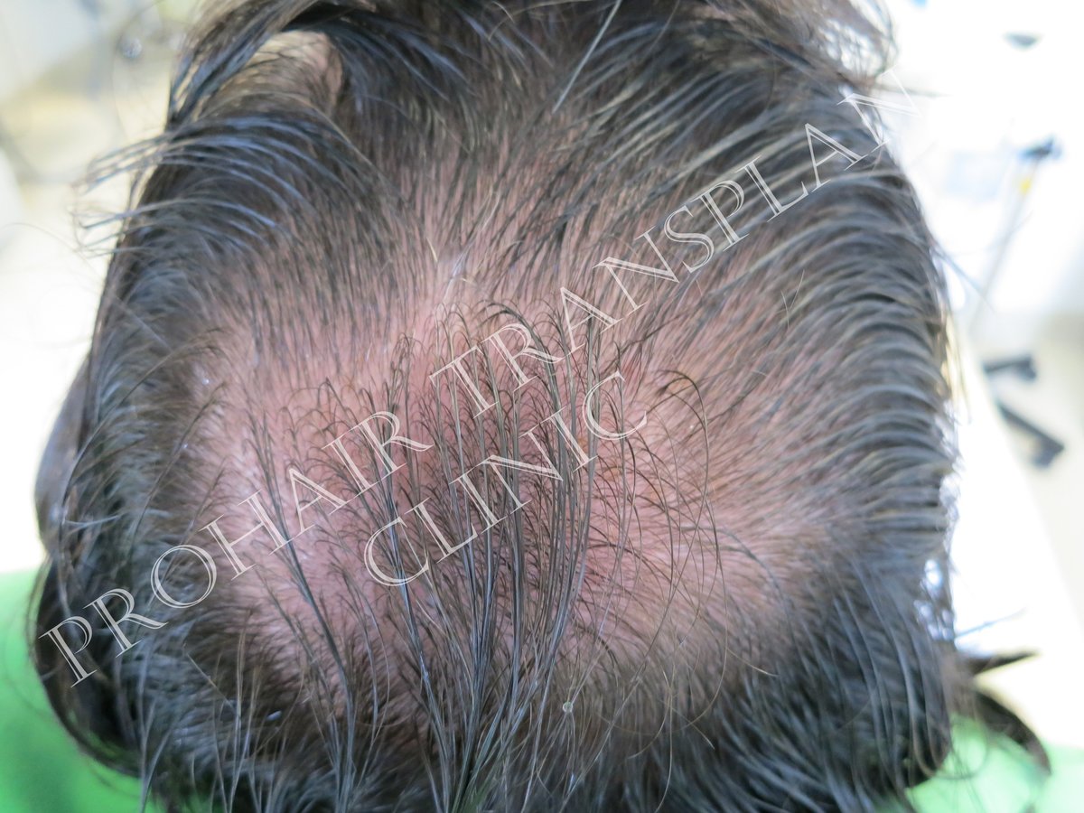 Pro Hair Transplant Clinic - Pro Hair Transplant Clinic
