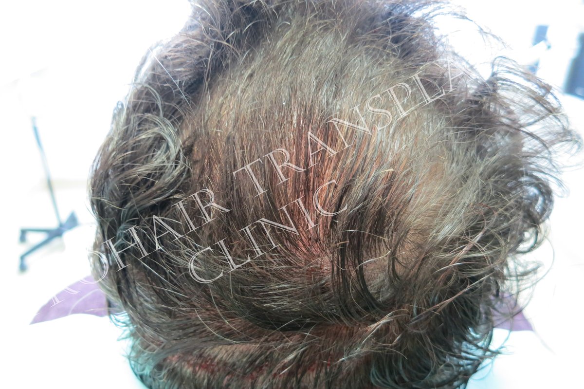 Pro Hair Transplant Clinic - Pro Hair Transplant Clinic