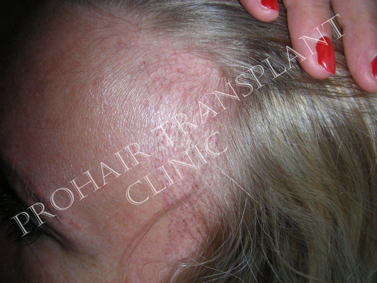 Pro Hair Transplant Clinic - Pro Hair Transplant Clinic