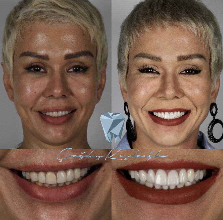 Prof. Dr. Cagdas Kislaoglu Cosmetic Dentistry - Prof. Dr. Cagdas Kislaoglu Cosmetic Dentistry
