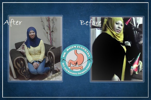 Professor Dr Hatem Elgohary (GIT and Bariatric Surgery) - Professor Dr Hatem Elgohary (GIT and Bariatric Surgery)