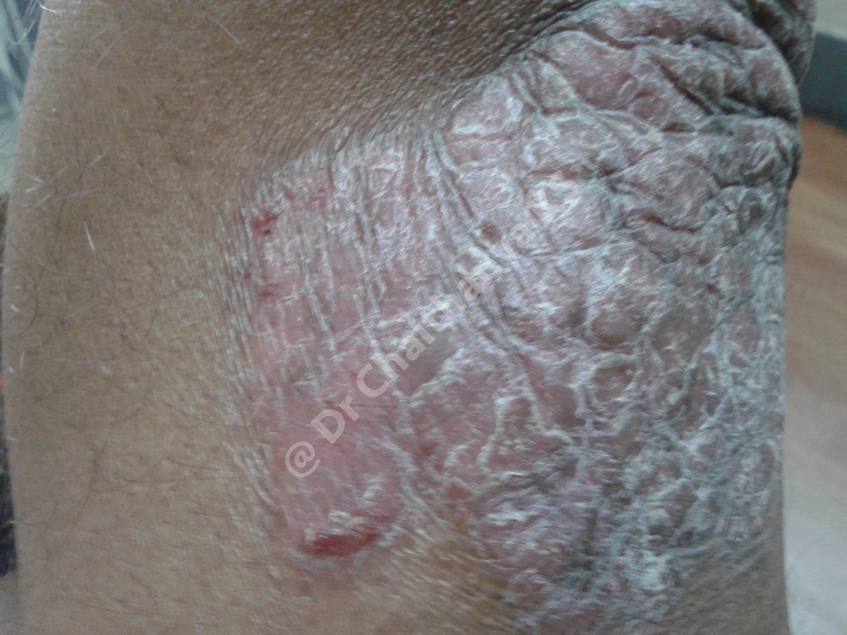 Psoriasis Clinic - Psoriasis Clinic