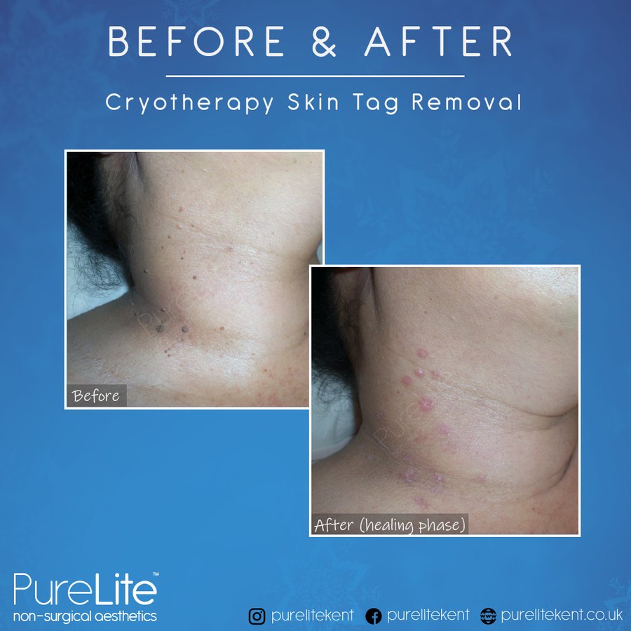 PureLite Non Surgical Aesthetics - PureLite Non Surgical Aesthetics