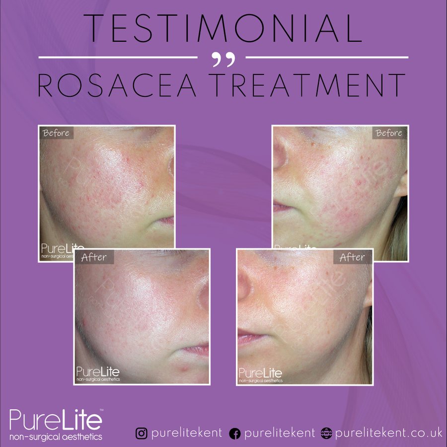 PureLite Non Surgical Aesthetics - PureLite Non Surgical Aesthetics