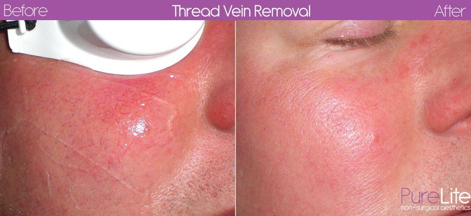 PureLite Non Surgical Aesthetics - PureLite Non Surgical Aesthetics