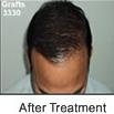 Radiance Hair Transplant Vijayawada - Radiance Hair Transplant Vijayawada