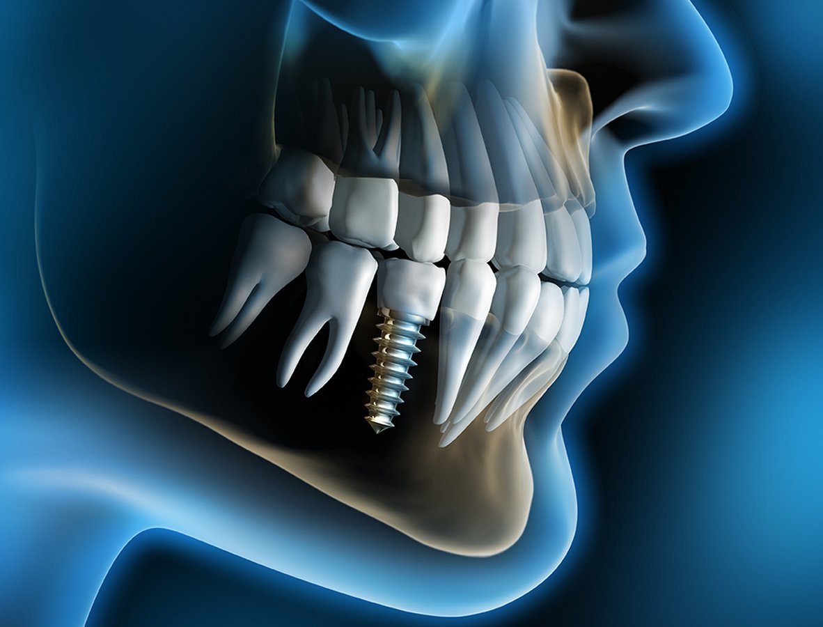 RAJKOT DENTAL - The Implant Centre - RAJKOT DENTAL - The Implant Centre
