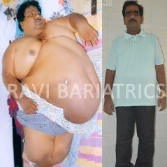 Ravi Bariatric and Obesity Clinic at Endocare - Ravi Bariatric and Obesity Clinic at Endocare