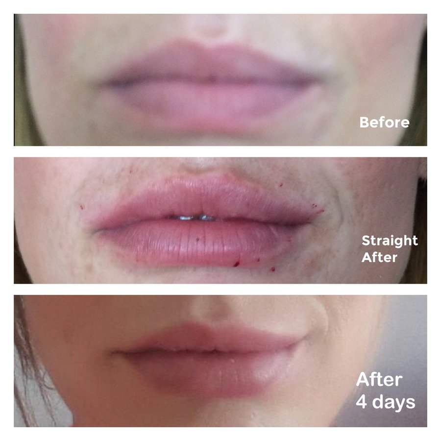 تحديث الحقن - Refresh Injections