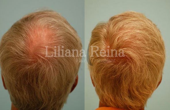 زرع الشعر رينا - Clinica D vinci Belleza y Salud - Reina Hair Transplant - Clinica D´vinci Belleza y Salud
