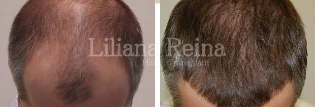 زرع الشعر رينا - Clinica D vinci Belleza y Salud - Reina Hair Transplant - Clinica D´vinci Belleza y Salud