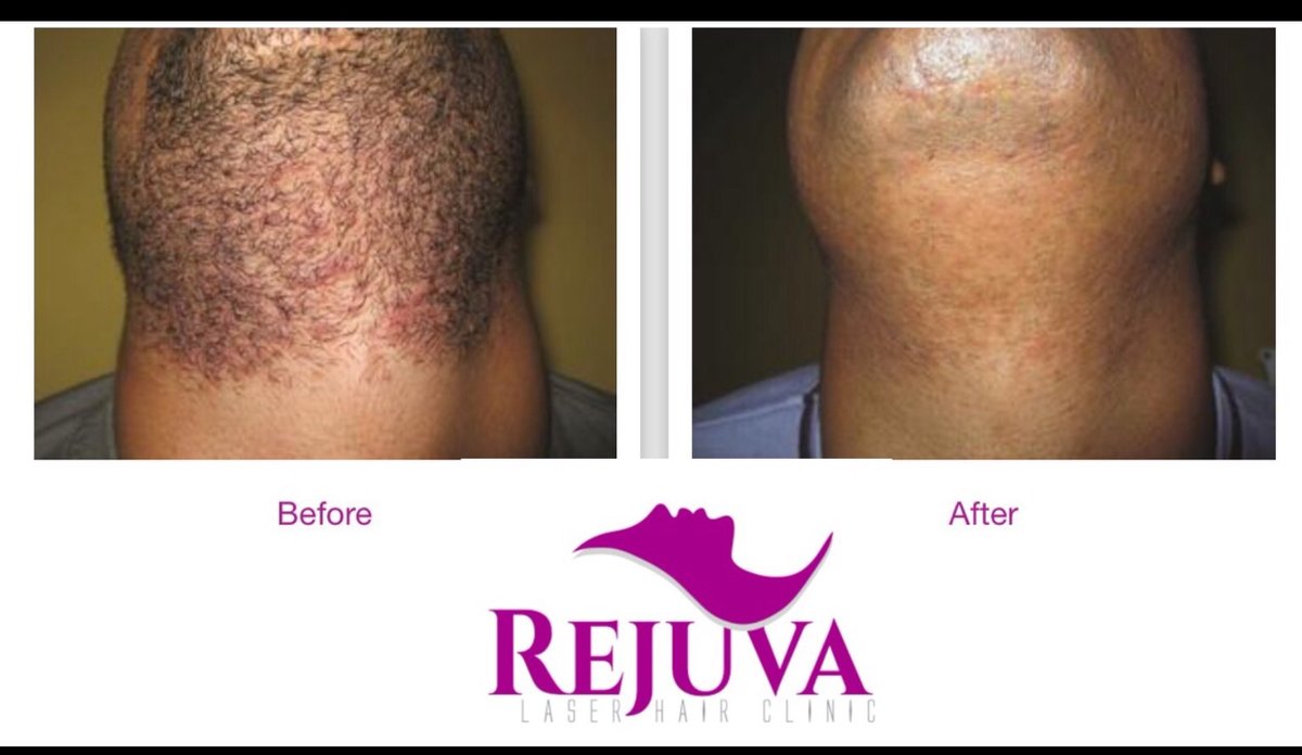 Rejuva Laser Hair Clinic - Rejuva Laser Hair Clinic