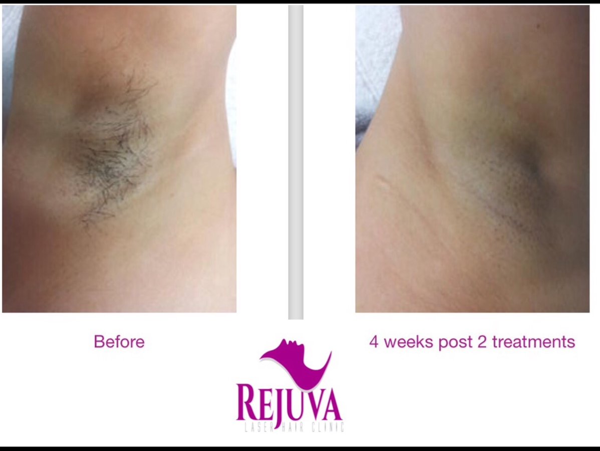 Rejuva Laser Hair Clinic - Rejuva Laser Hair Clinic