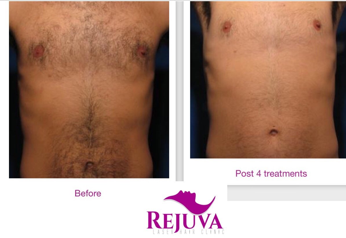 Rejuva Laser Hair Clinic - Rejuva Laser Hair Clinic