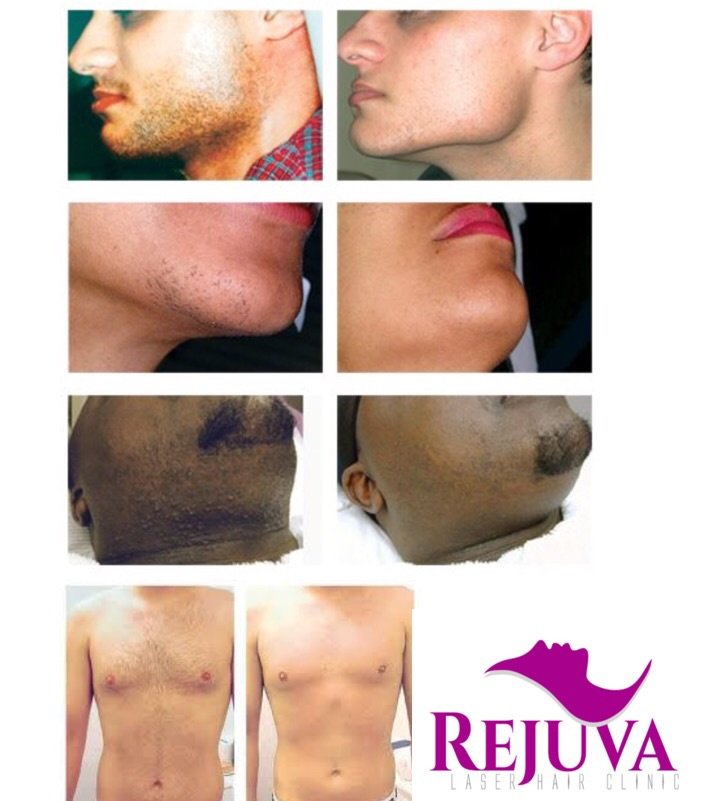 Rejuva Laser Hair Clinic - Rejuva Laser Hair Clinic