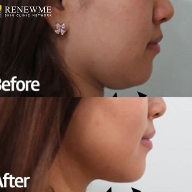 Renewme Skin Clinic Bangkok - Renewme Skin Clinic Bangkok