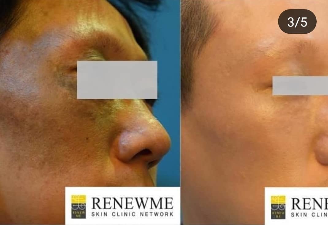 Renewme Skin Clinic Bangkok - Renewme Skin Clinic Bangkok