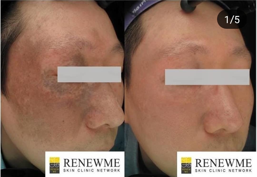 Renewme Skin Clinic Bangkok - Renewme Skin Clinic Bangkok