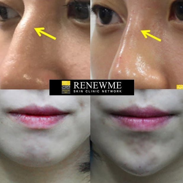 Renewme Skin Clinic Bangkok - Renewme Skin Clinic Bangkok