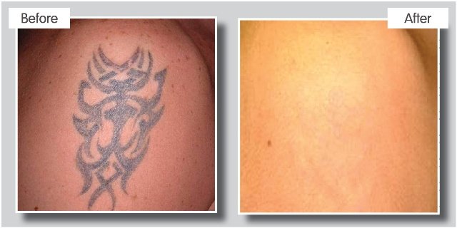 ReThink إزالة الوشم بالليزر - ReThink Laser Tattoo Removal