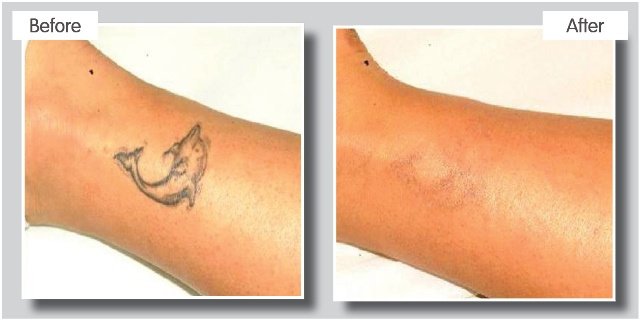 ReThink إزالة الوشم بالليزر - ReThink Laser Tattoo Removal