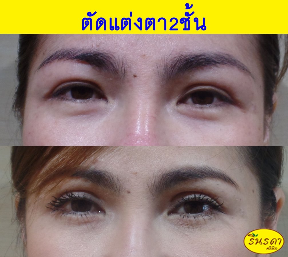 Rinrada Cosmetic & Plastic Surgery Clinic Pattaya - Rinrada Cosmetic & Plastic Surgery Clinic Pattaya