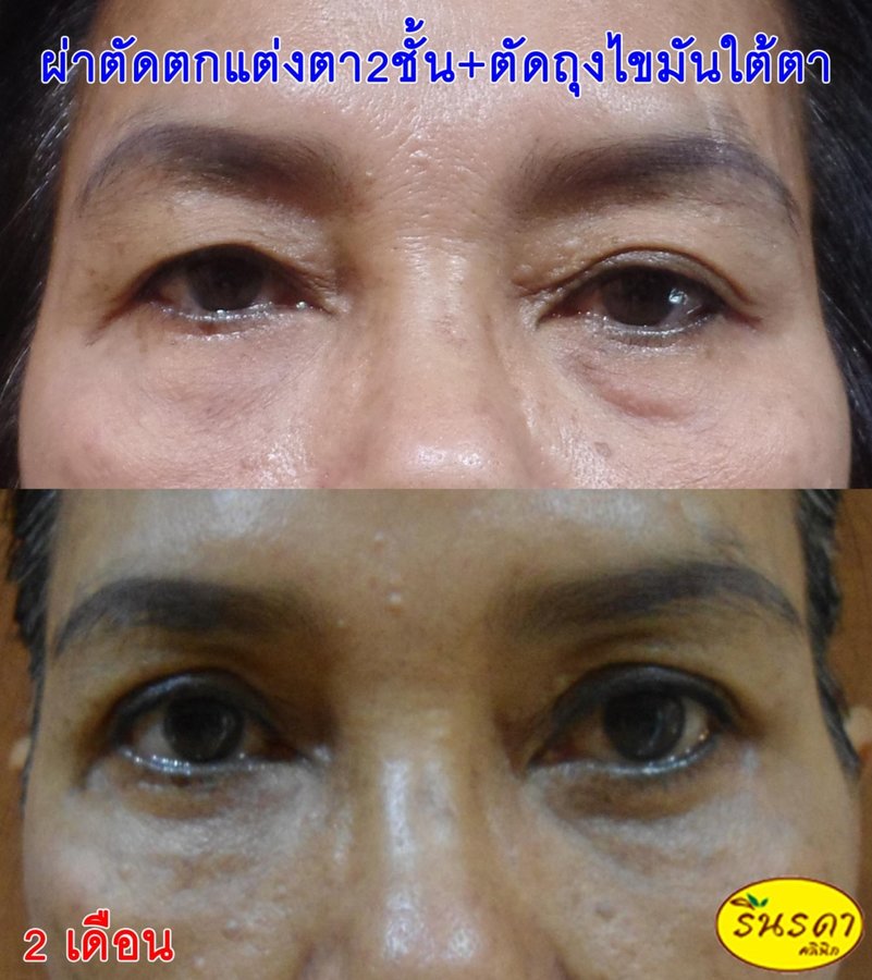 Rinrada Cosmetic & Plastic Surgery Clinic Pattaya - Rinrada Cosmetic & Plastic Surgery Clinic Pattaya