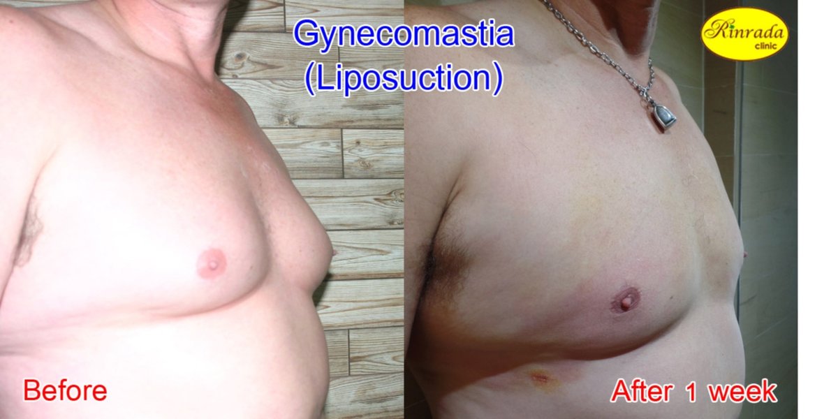 Rinrada Cosmetic & Plastic Surgery Clinic Pattaya - Rinrada Cosmetic & Plastic Surgery Clinic Pattaya