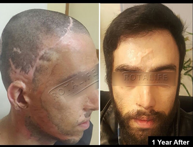 زراعة الشعر روتا - مركز إزمير - Rota Hair Transplant - Izmir Center