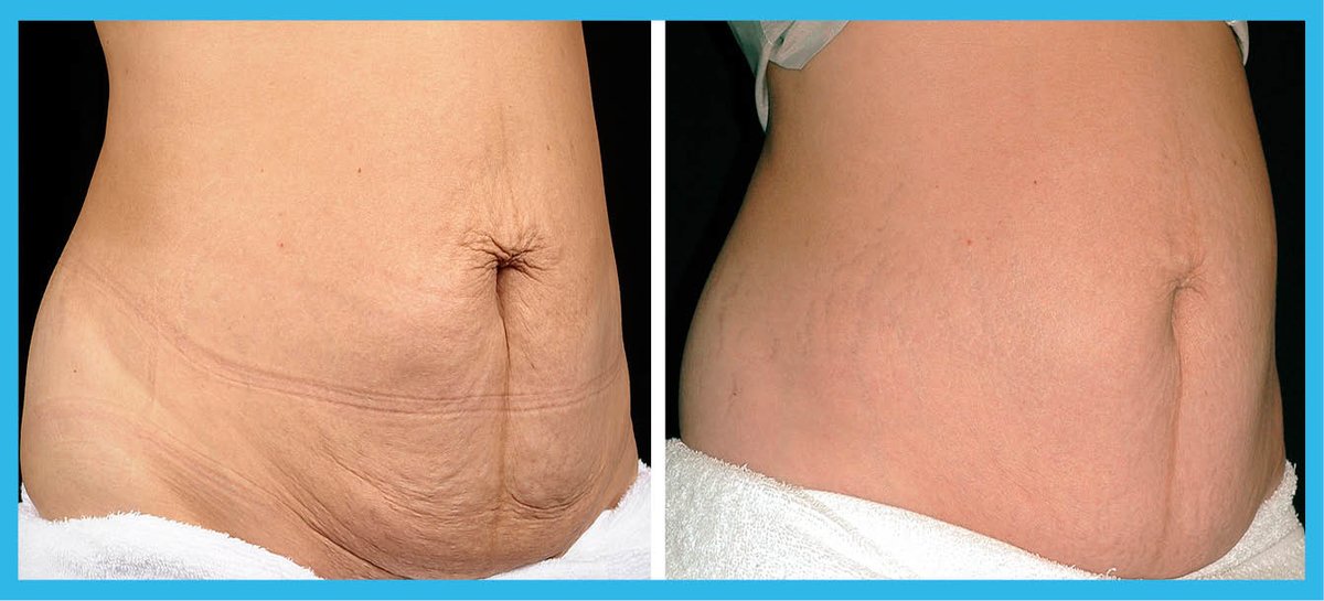 Saphira Thermage - Byron Bay - Saphira Thermage - Byron Bay