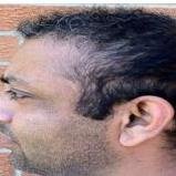 مركز ساتيام لزراعة الشعر دلهي - Satyam Hair Transplant Centre Delhi