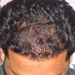 مركز ساتيام لزراعة الشعر دلهي - Satyam Hair Transplant Centre Delhi