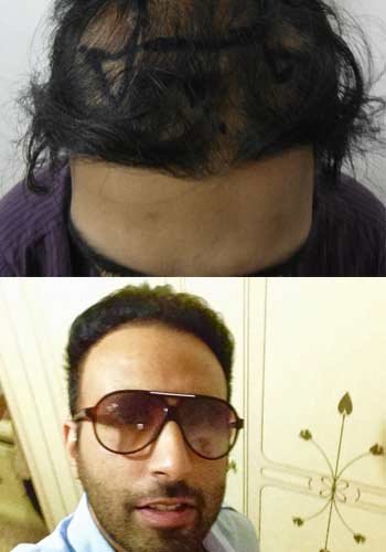 Satyam Hair Transplant Russia - Satyam Hair Transplant Russia