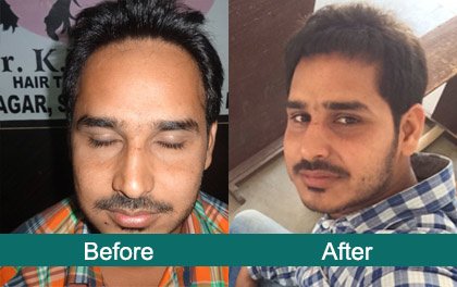 Satyam Hair Transplant Russia - Satyam Hair Transplant Russia