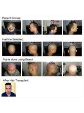 Satyam Hair Transplant Russia - Satyam Hair Transplant Russia
