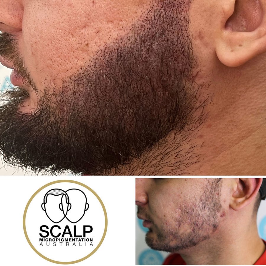 Scalp Micro Pigmentation Australia - Scalp Micro Pigmentation Australia