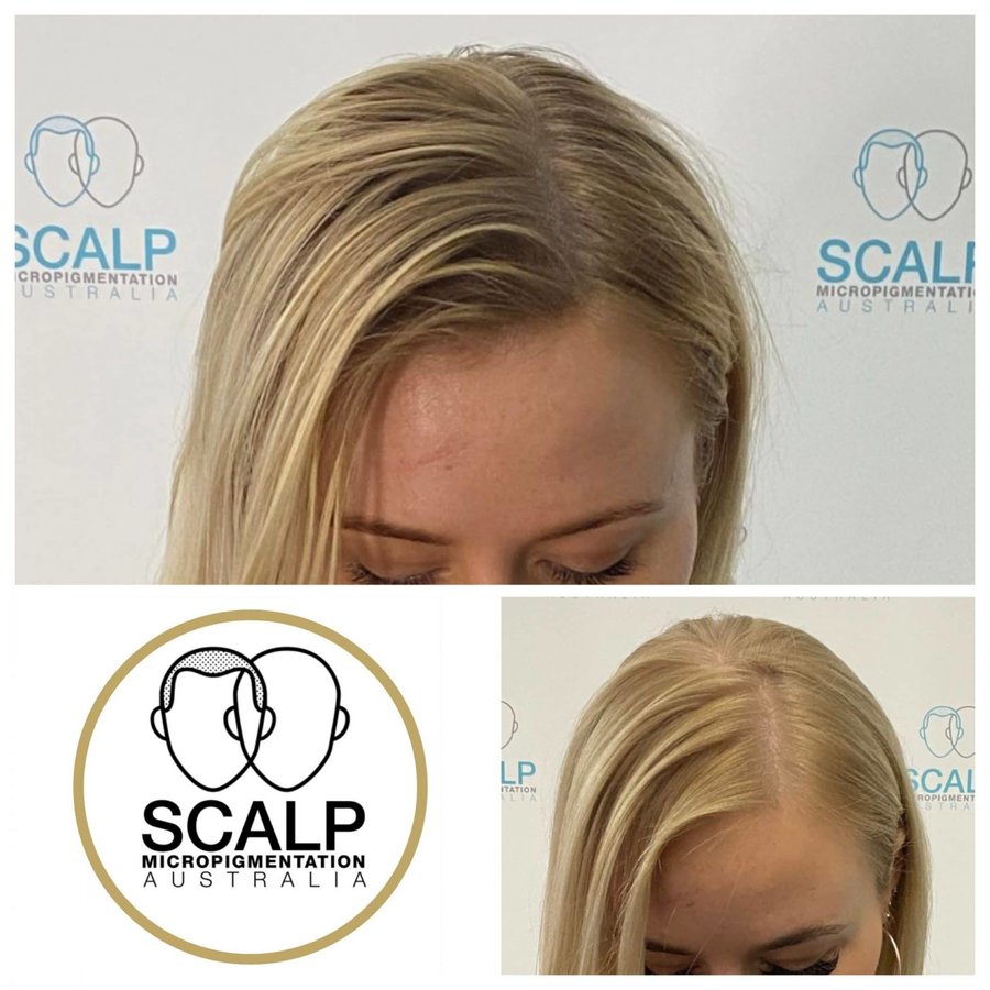 Scalp Micro Pigmentation Australia - Scalp Micro Pigmentation Australia